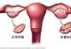 终于改名!这个病困扰全球1.7亿女性,却被“叫错”90年
