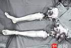 男子双大腿被绞断完全分离，经手术重新“接”回