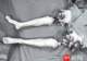 男子双大腿被绞断完全分离,经手术重新“接”回