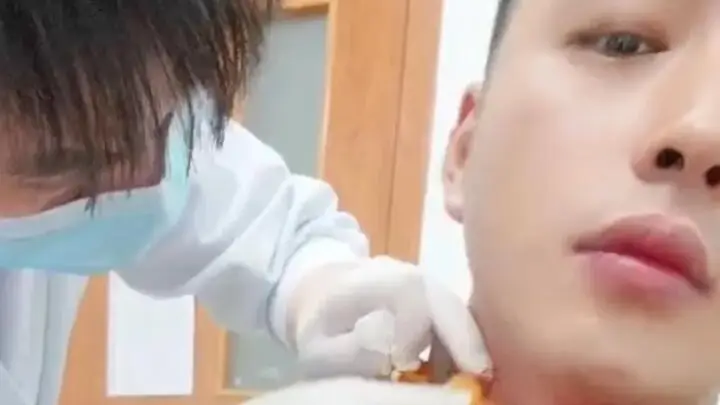 男子被蚊子叮咬脖子,抓挠后血流1小时不止,足足400毫升,当事人最新发声;接诊医生称“第一次遇到”,可能和刚健身完有关