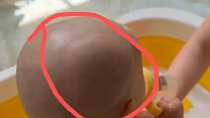宝宝从餐椅跌落,家中老人不敢告知孩子父母,两天后孩子确诊头骨骨折
