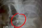 三岁男童吞磁力珠奶奶轻视 医生邻居紧急提醒