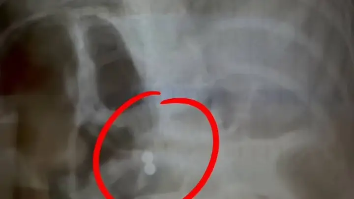 三岁男童吞磁力珠奶奶轻视 医生邻居紧急提醒