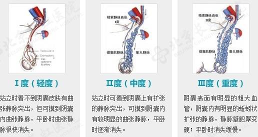 备孕两年无果，28岁杭州男子傻眼：这里竟藏了一窝“蚯蚓”！医生：千万别小看了