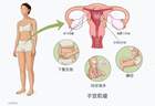 杭州一女子常被误认怀孕,腹中竟藏着50颗子宫肌瘤